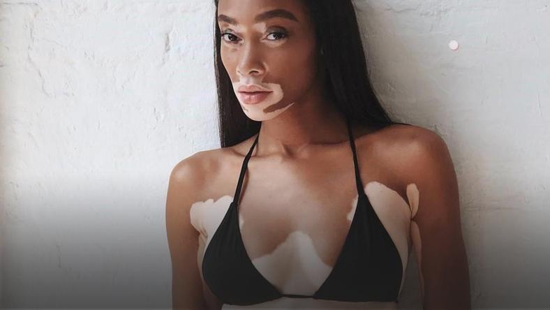 Modelka cierpiąca na bielactwo nowym aniołkiem Victoria's Secret