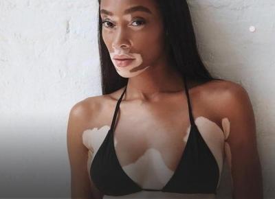 Modelka cierpiąca na bielactwo nowym aniołkiem Victoria's Secret