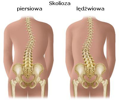 life with scoliosis: O skoliozie