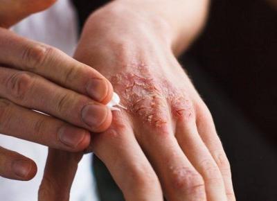 Dziś jest Międzynarodowy Dzień Łuszczycy