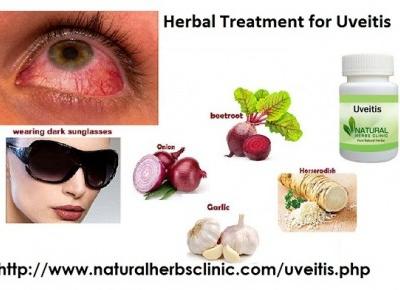 Herbal Treatment for Uveitis