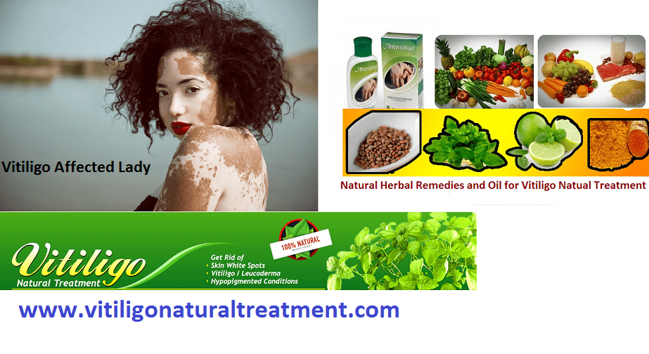 Vitiligo its Appearance and Treatments with Natural Herbs and Pure Herbal Vitiligo Oil