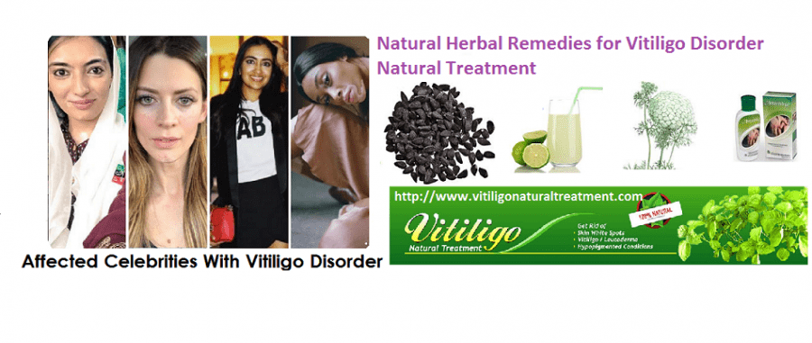 Vitiligo Natural Treatment
