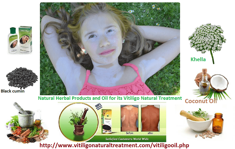 Skin Disorder Vitiligo and Natural Herbal Products and Oil for its Treatment