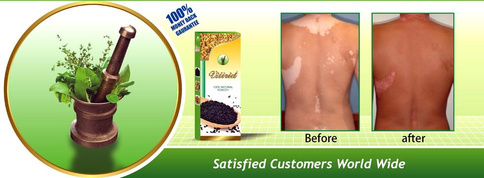Vitiligo Oil, Anti Vitligo Herbal Oil, Natural Vitiligo Treatment & Cure