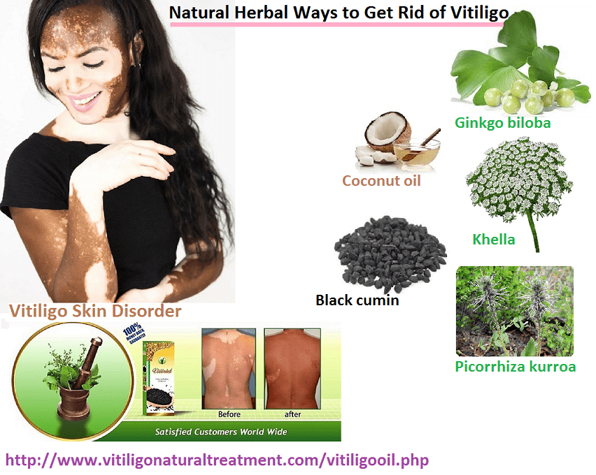 Causes, Symptoms and Natural Herbal Ways to Get Rid of Vitiligo