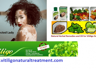 Vitiligo its Appearance and Treatments with Natural Herbs and Pure Herbal Vitiligo Oil