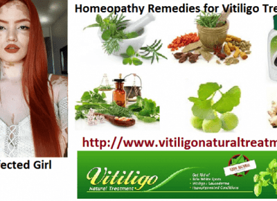 Vitiligo and its Natural Treatment with Homeopathy Method