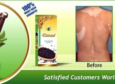 Vitiligo Natural Treatment, Anti Vitiligo Herbal Treatment &Cure;